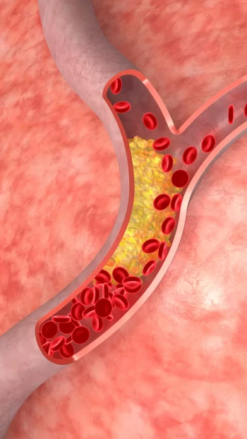 Où se situent les plaques d'athérome ?